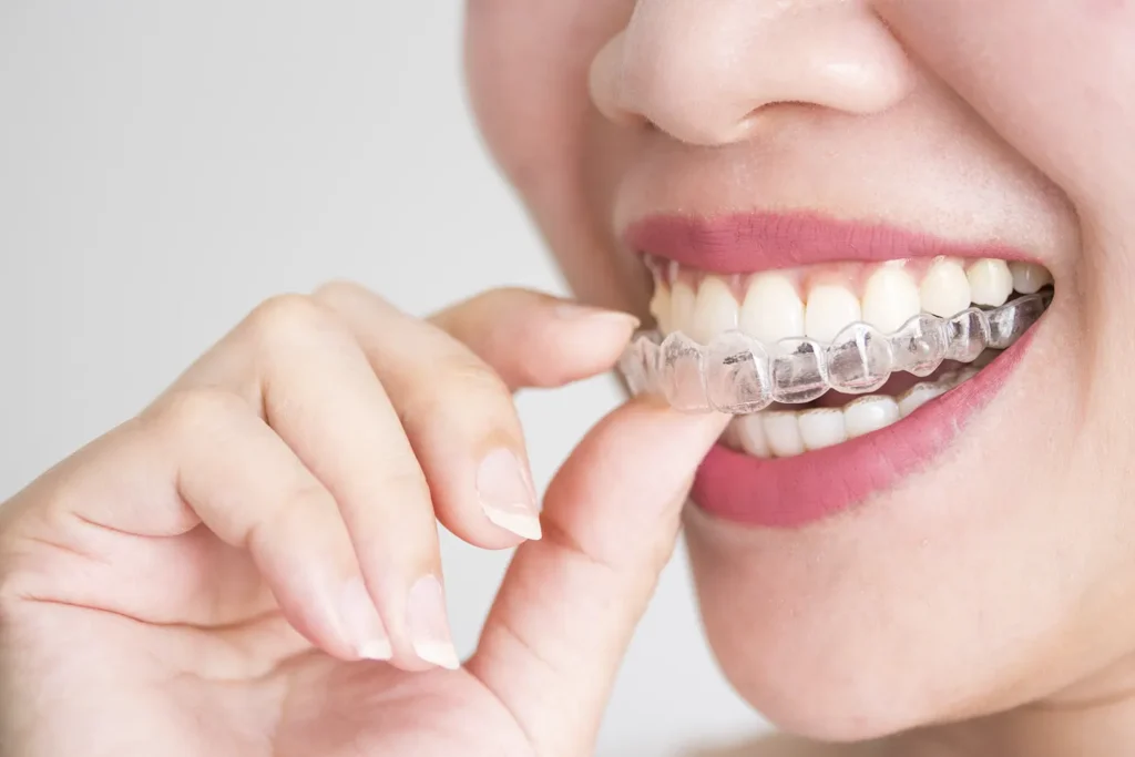 Invisalign