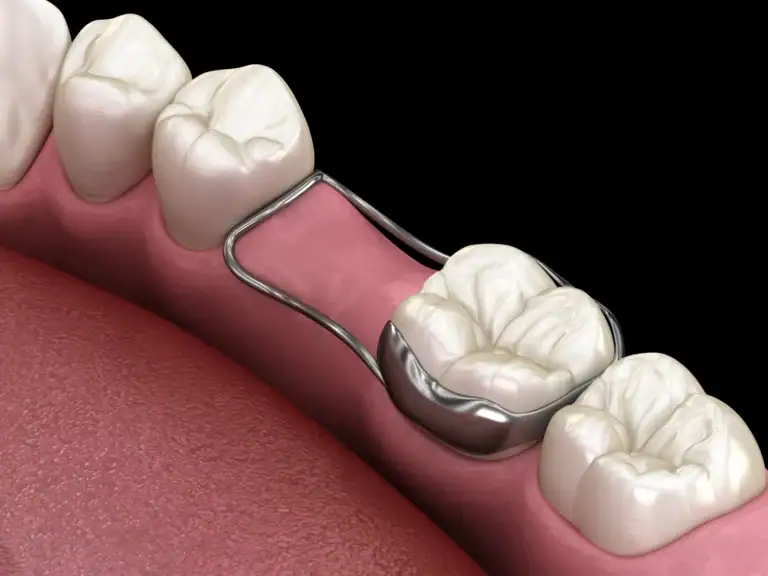 What Are Space Maintainers for Teeth?
