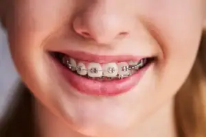 Do Braces Move Your Child’s Teeth Every Day?