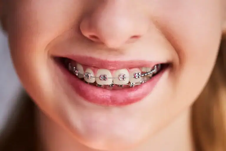 Do Braces Move Your Child’s Teeth Every Day?