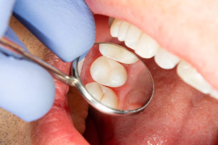 child dental sealant 