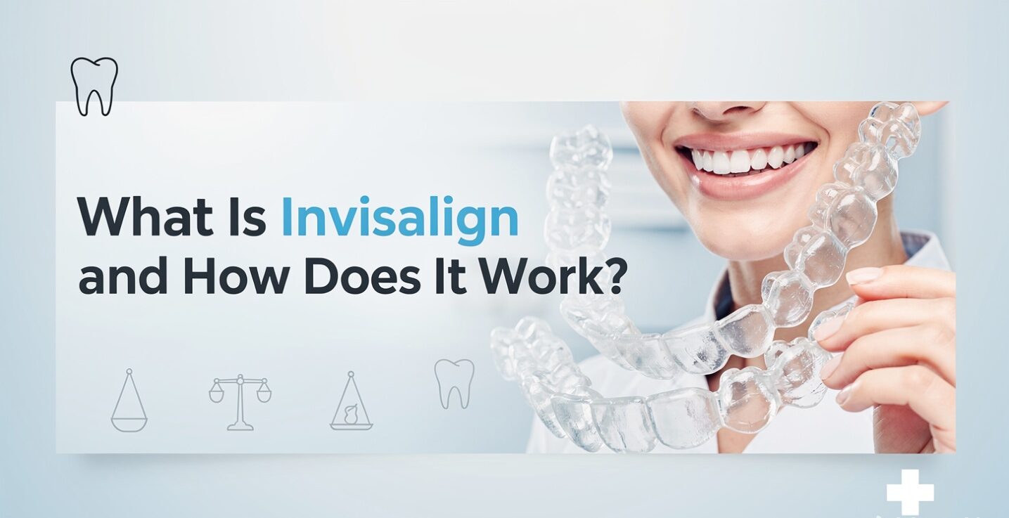 What Is Invisalign and How Does It Work?